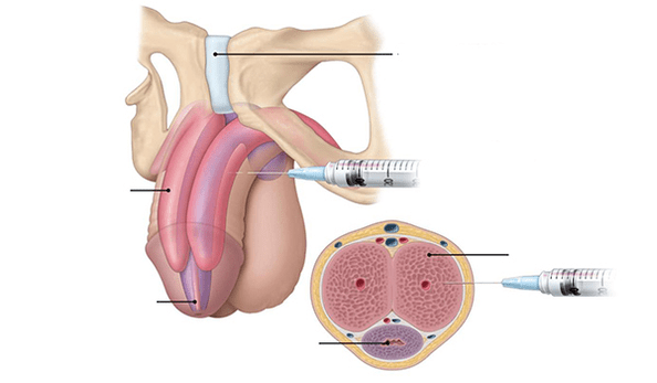 Injection of your own fat tissues for penis thickness